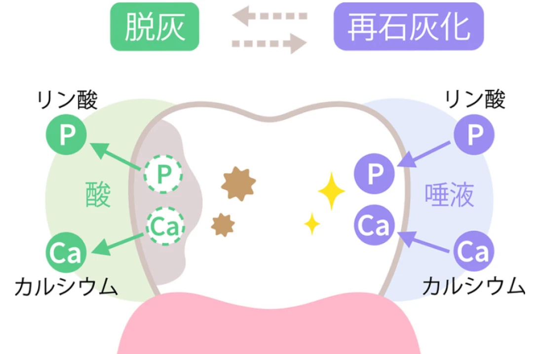 初期の虫歯は再石灰化で治せます