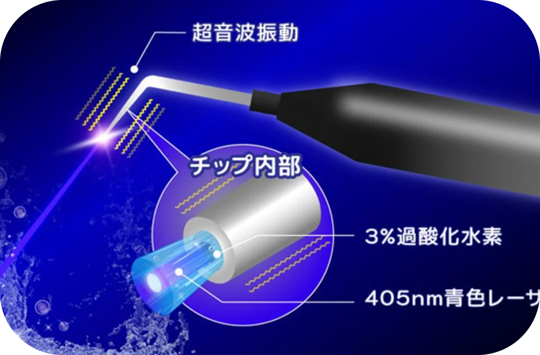ブルーラジカル歯周病治療