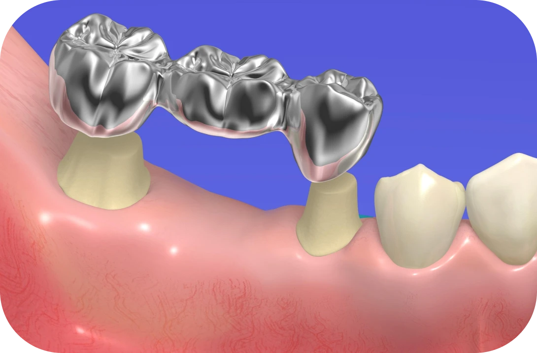 銀歯とセラミックの違い