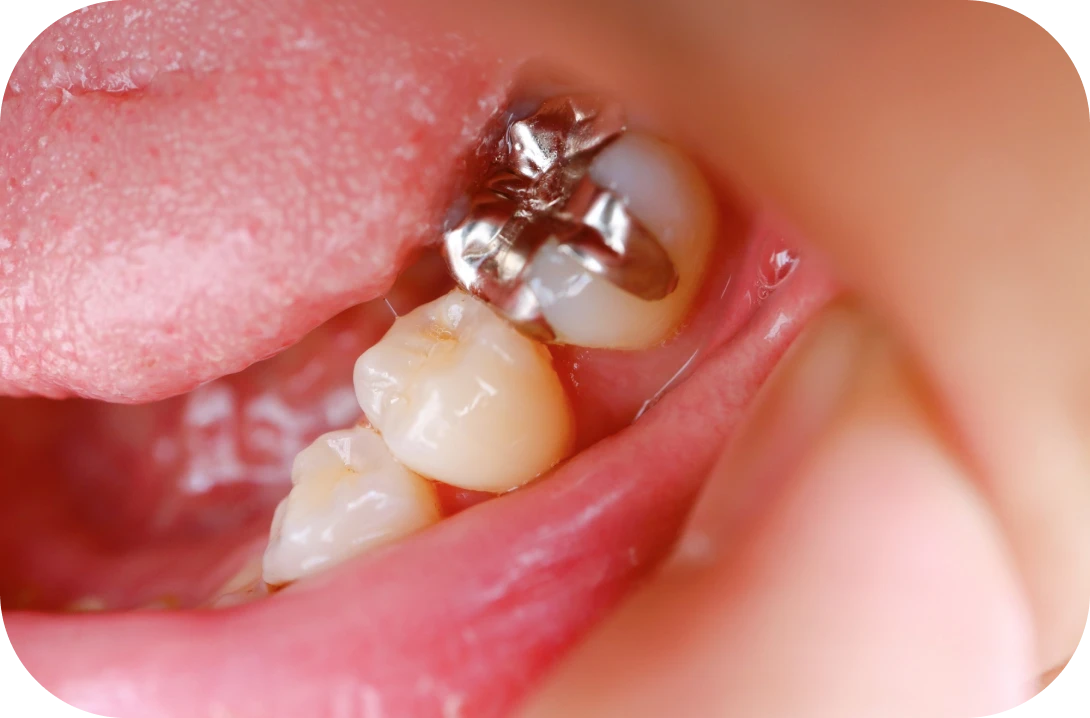 銀歯は金属アレルギーの恐れあり